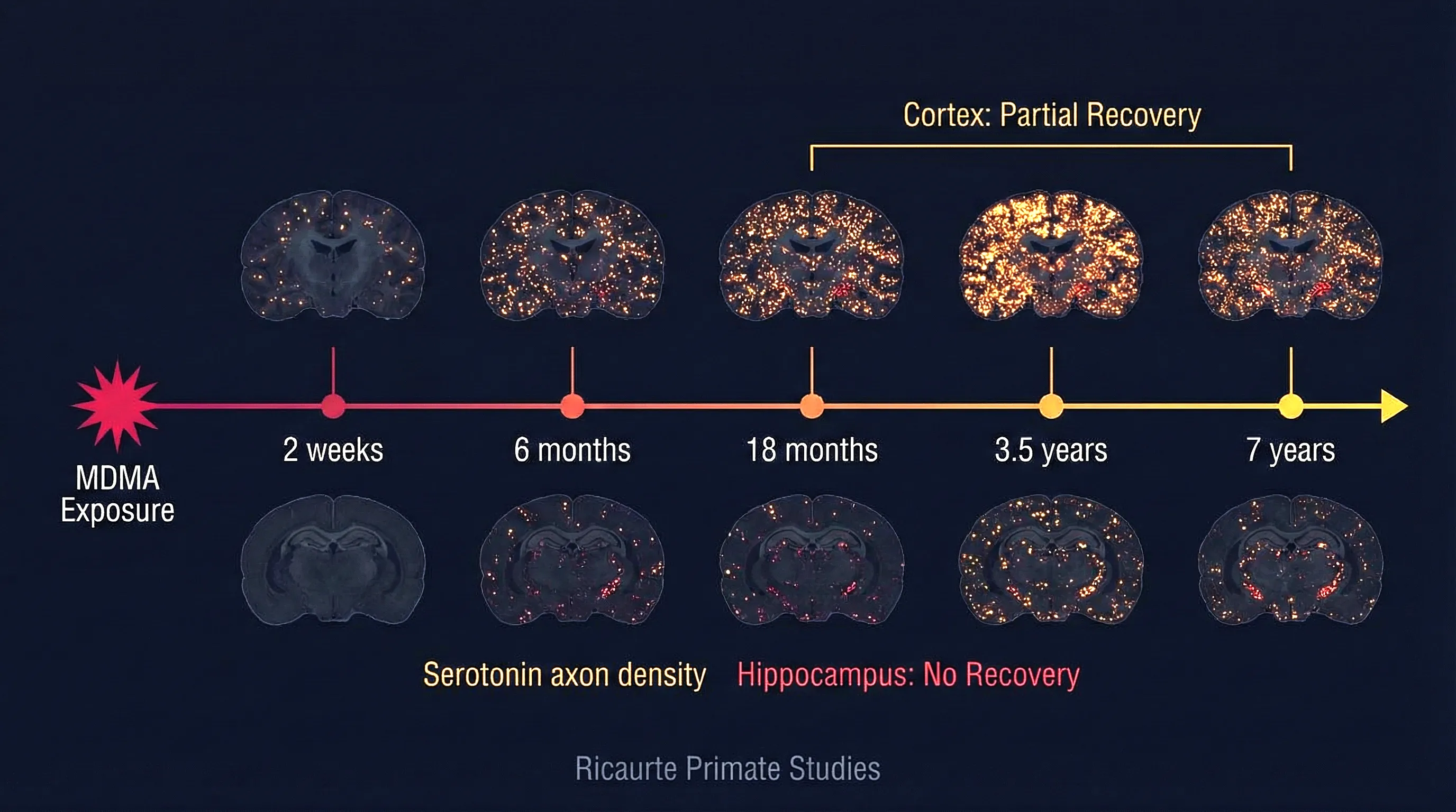 Why MDMA memory damage persists after quitting